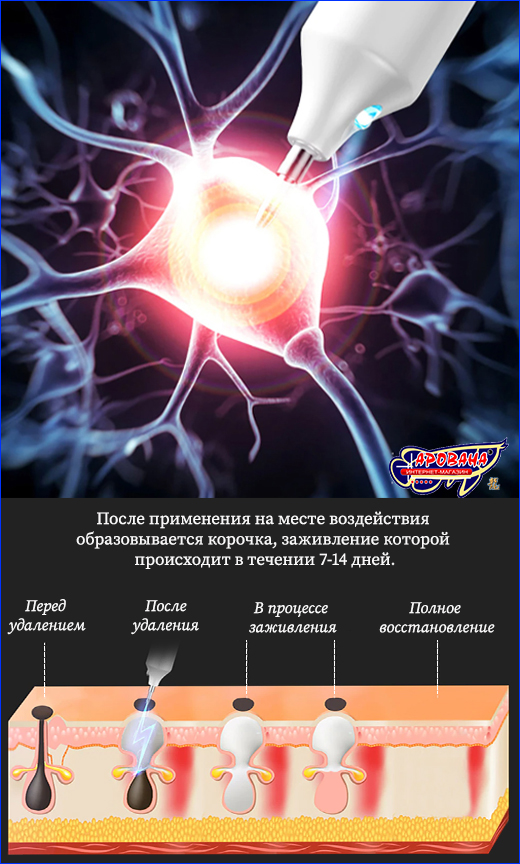 Плазменная ручка коагулятор. Коагулятор плазменный, Plasma Pen.